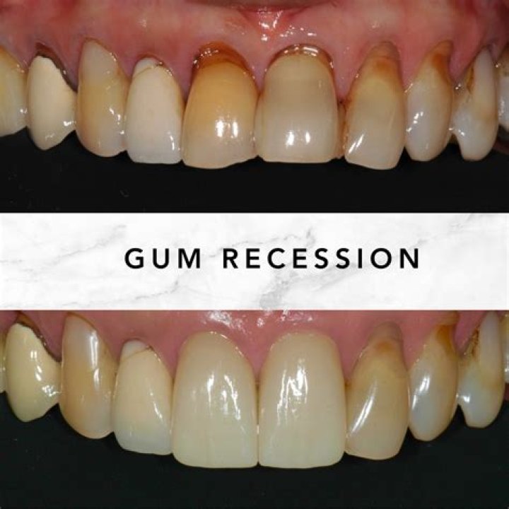 Can a dentist restore receding gums?
