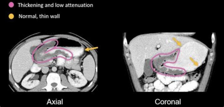 Can a hernia be seen on a CT scan?