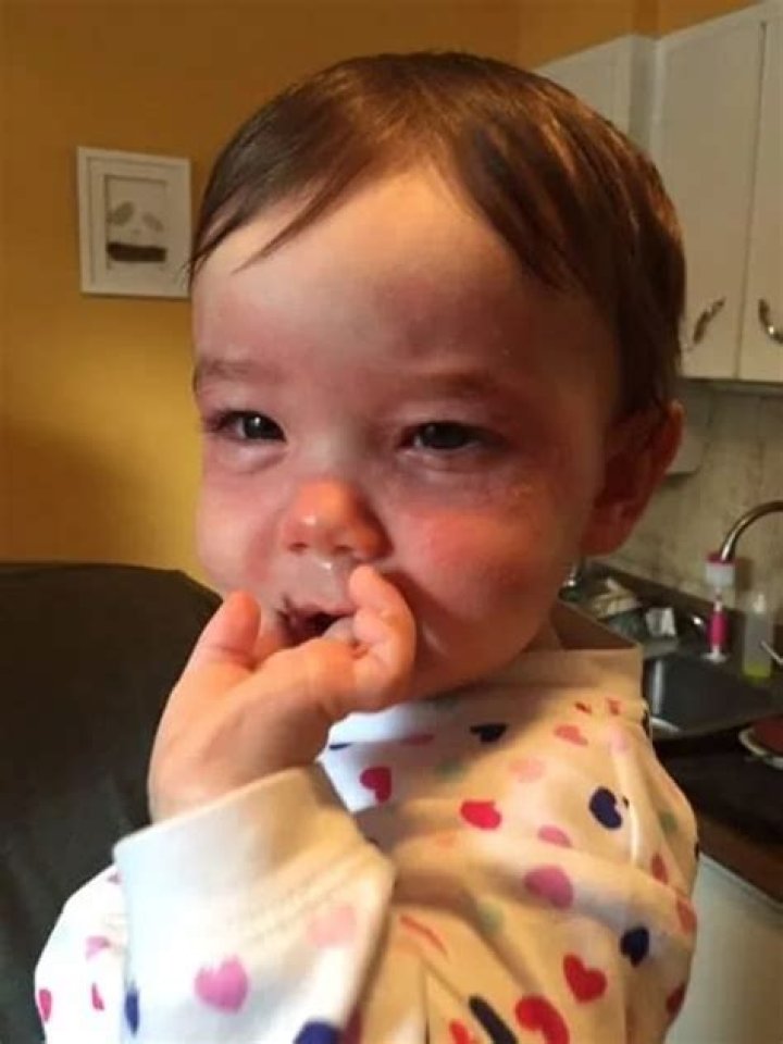 Can babies be allergic to cashews?