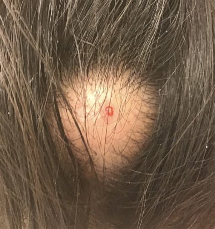 Can I pop a pilar cyst?