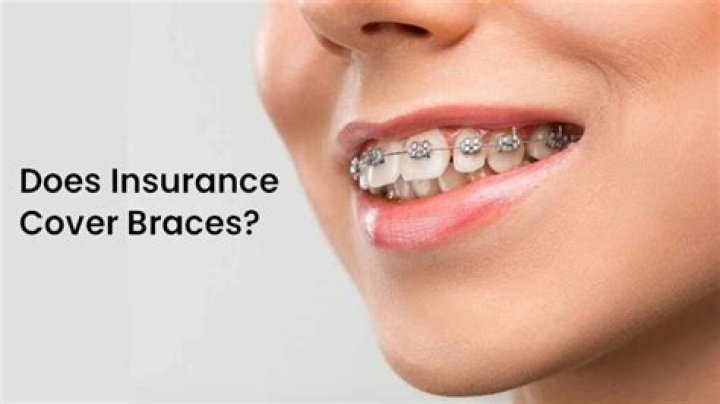 Can insurance cover braces?