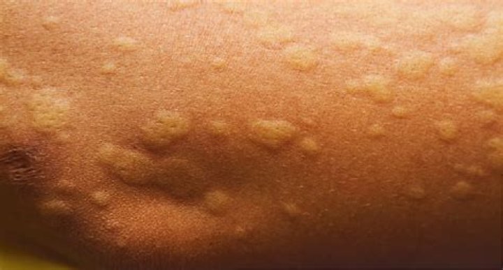 Can sugar cause hives?