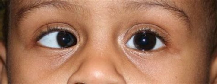 Can TV cause strabismus?