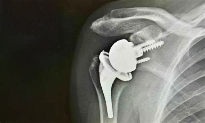 Can you have an MRI with a total shoulder replacement?
