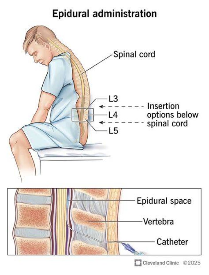Can you sleep with epidural?