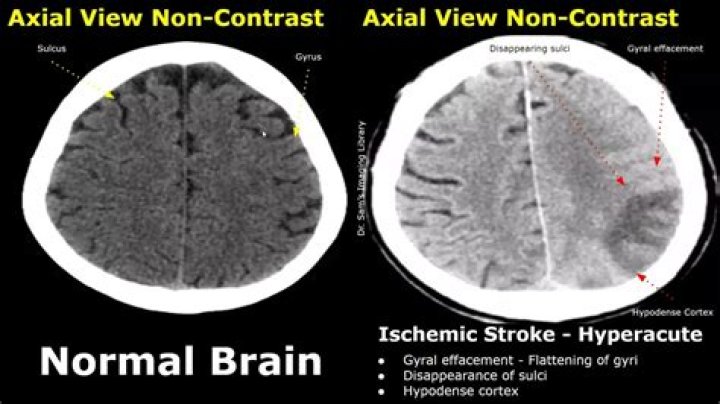 Do all strokes show up on CT scan?
