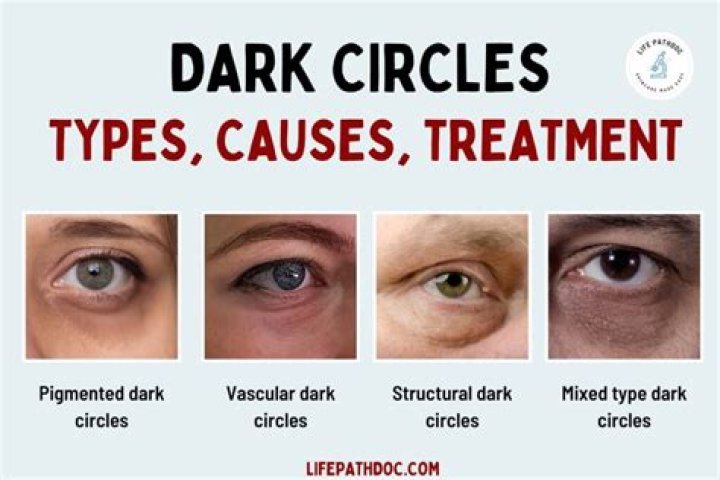 Does honey help dark circles?