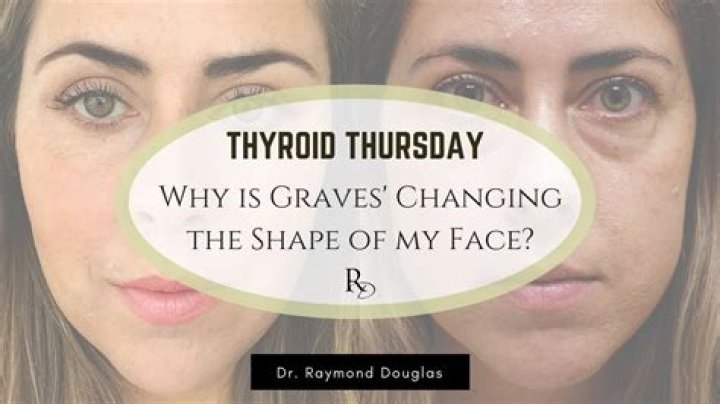 Does hypothyroidism change your face?