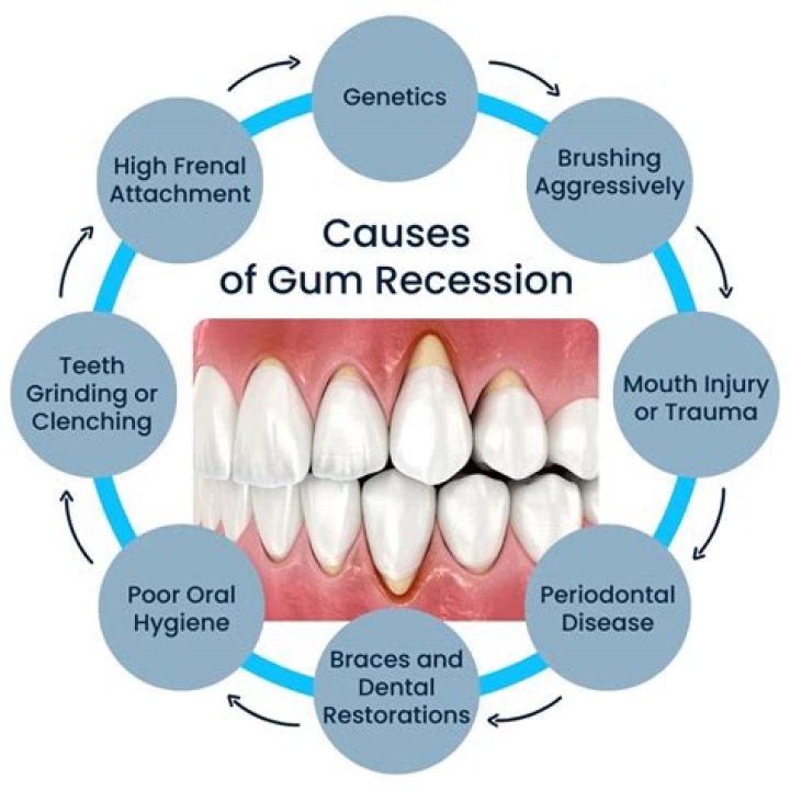 Does Sensodyne help with gum recession?