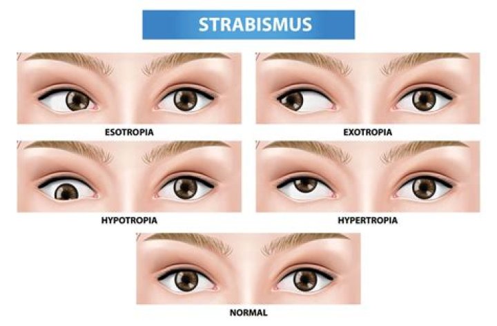 How do glasses treat strabismus?