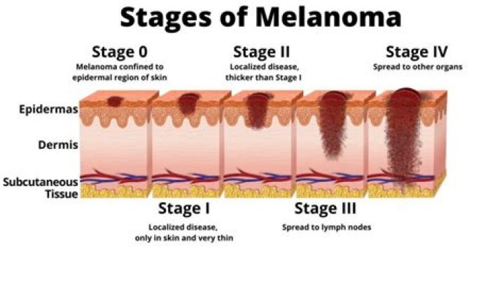 How do I know if melanoma has spread?