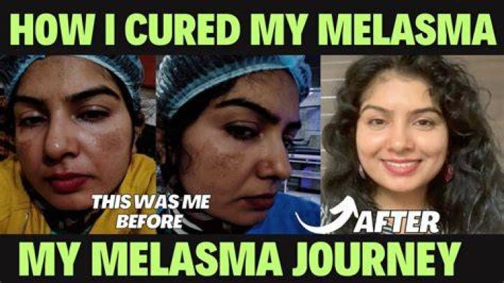 How I cured my melasma?