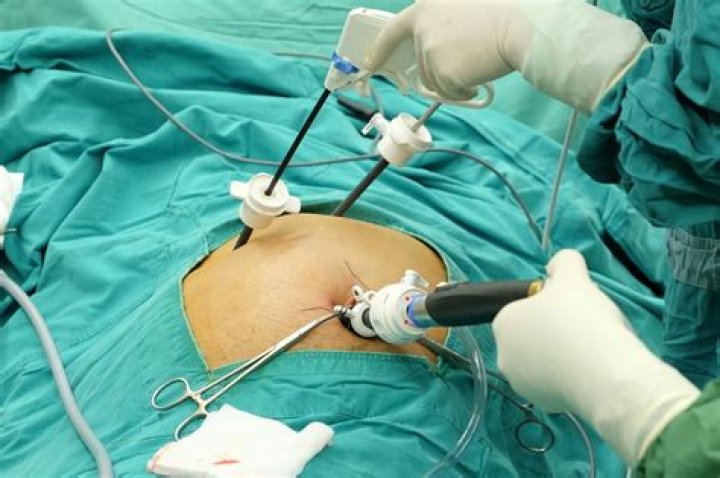 How long does a gallbladder operation take?