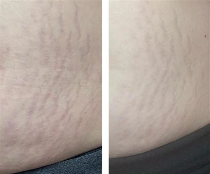 How long does it take for stretch marks to fade?