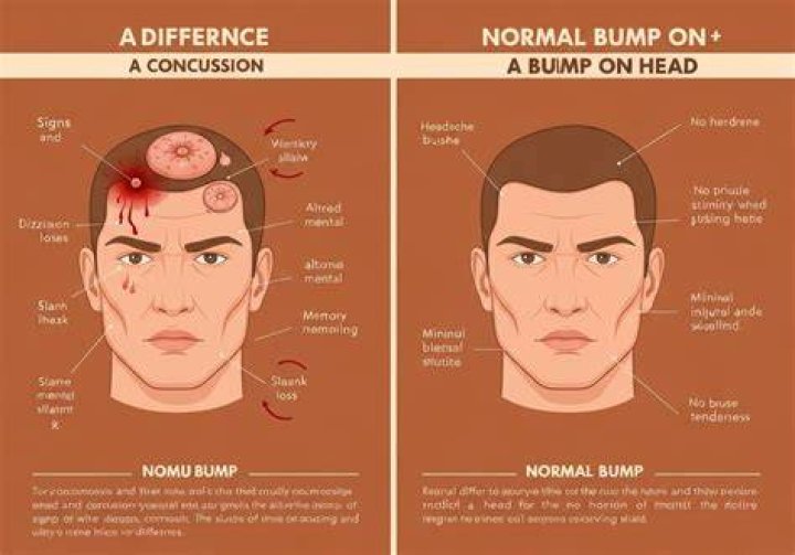 Is every bump on the head a concussion?