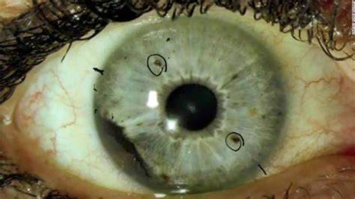 Is eye melanoma rare?