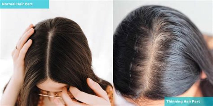 Is GREY hair normal at 13?