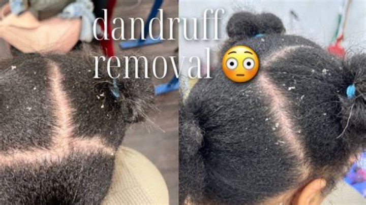 Is it good to scratch dandruff?