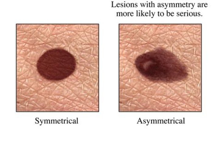 Is melanoma ever light brown?