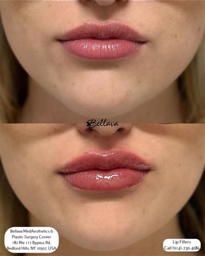 Should lips be hard after filler?