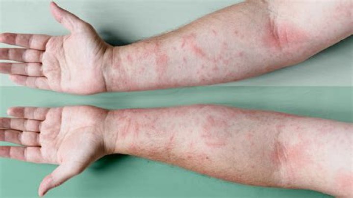 What climate is good for eczema?