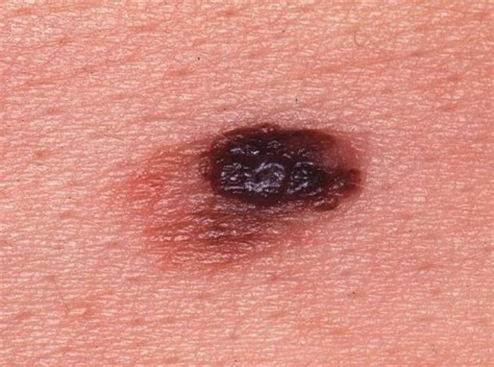 What do malignant moles look like?