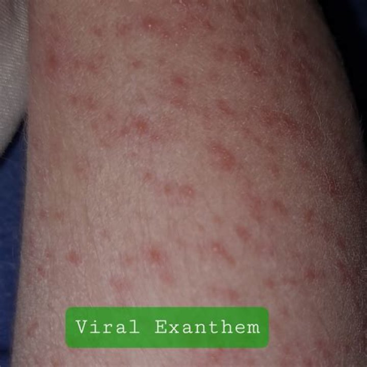 What does a virus rash look like?