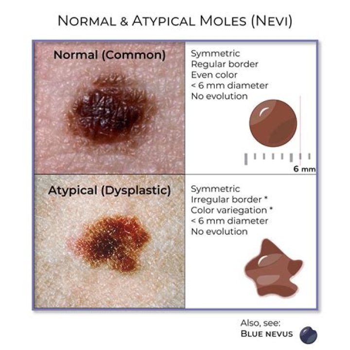 What does an infected mole look like?