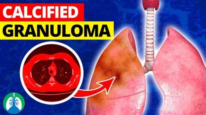 What does granuloma feel like?