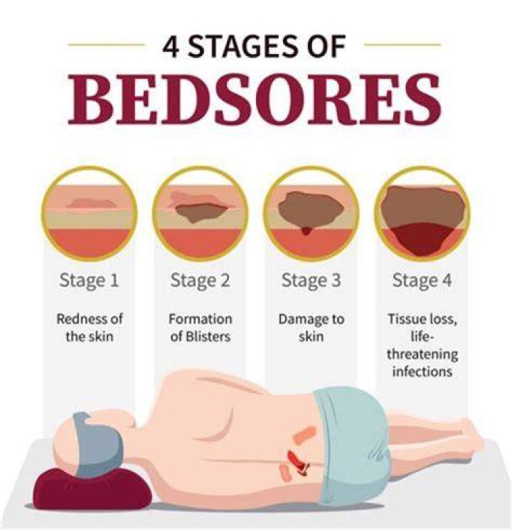 What happens if a bed sore reaches the bone?