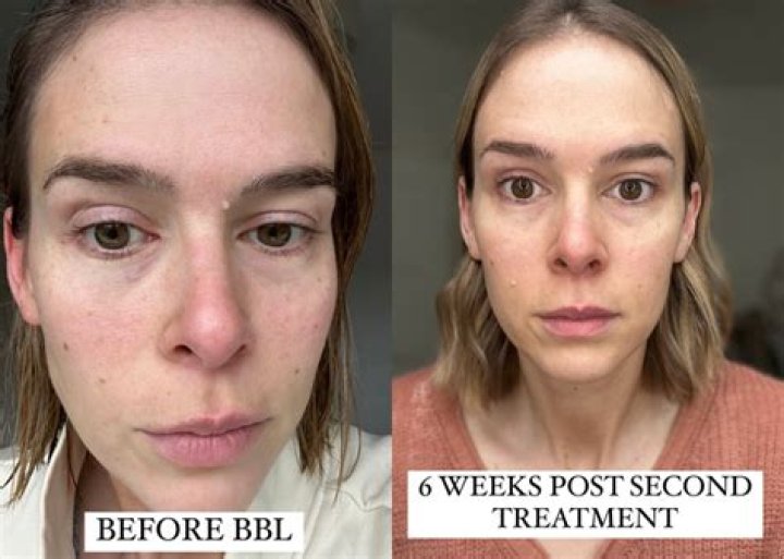 What happens to a BBL after years?