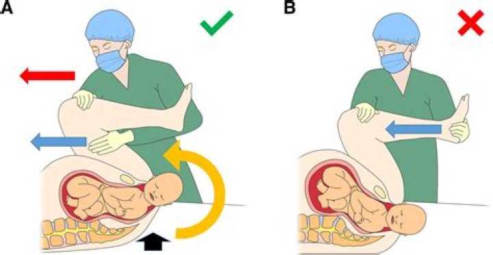 What is Bracht maneuver?