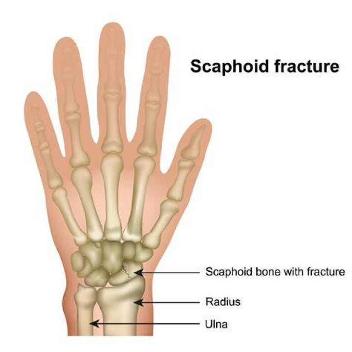 What is scaphoid fracture?