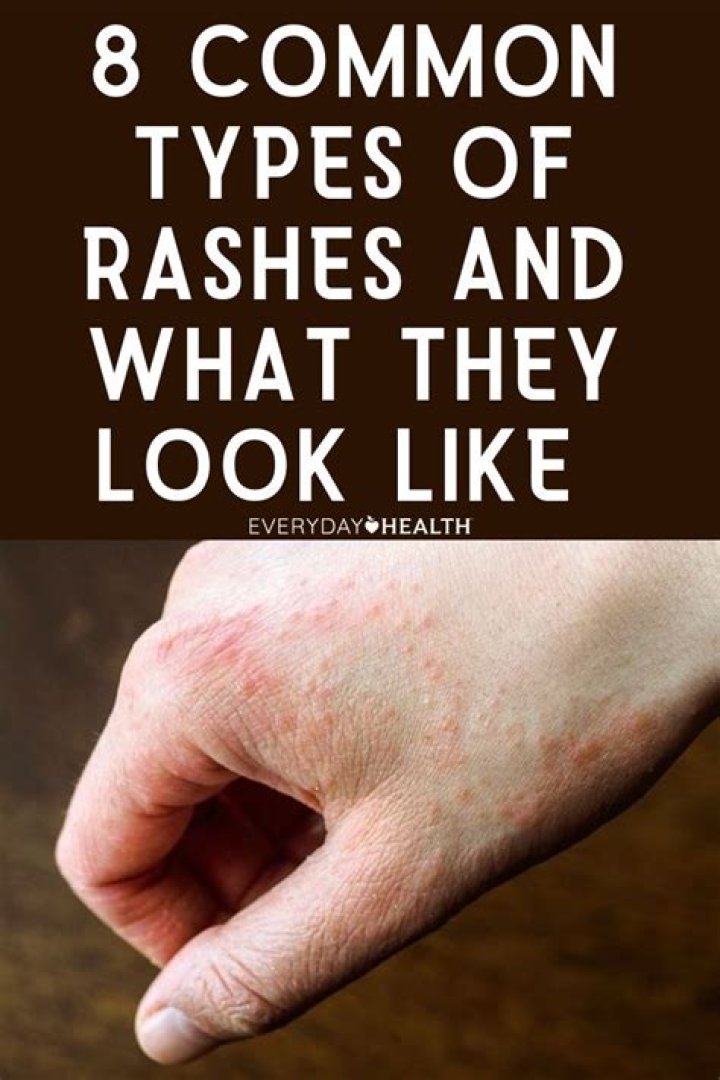 What to put on a rash that itches?