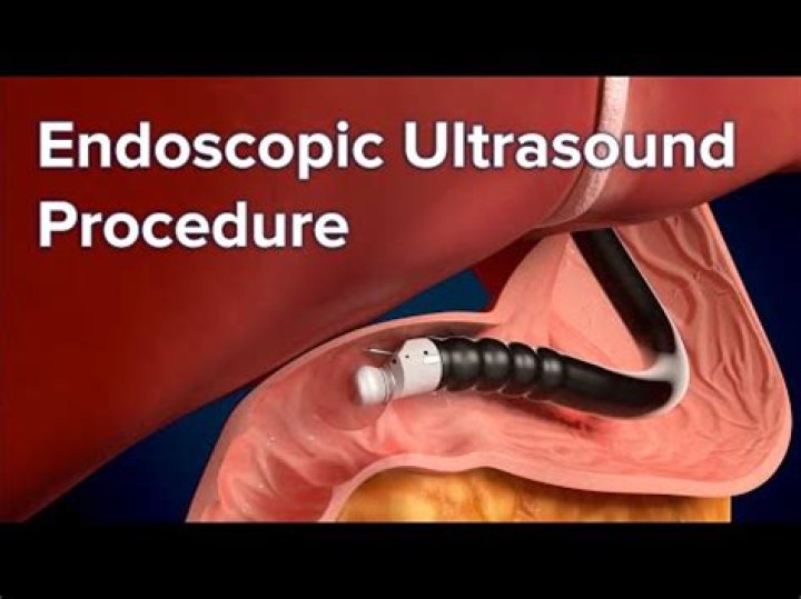 Which is better MRI or endoscopy?