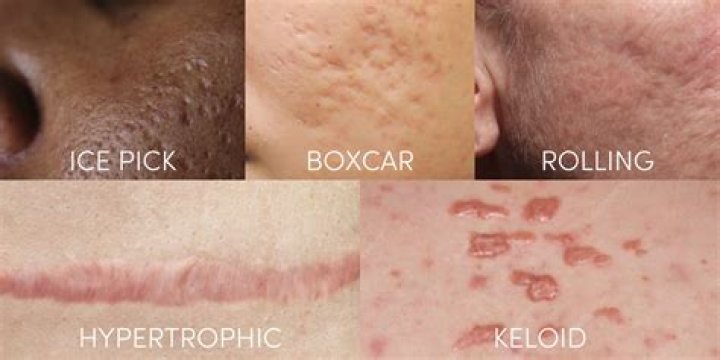 Why does my scar feel lumpy?