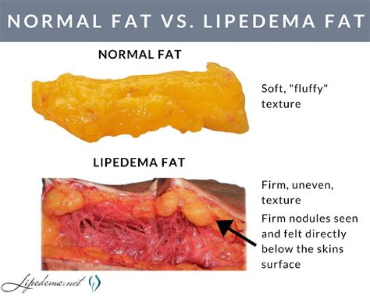 Why is my fat hard and lumpy?