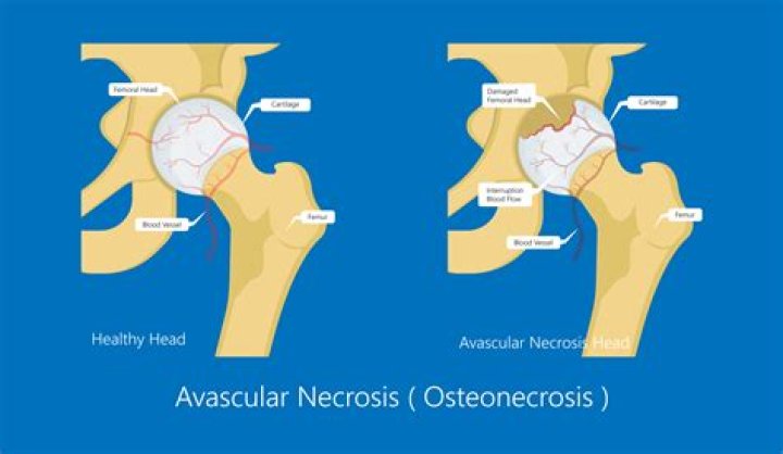Will a bone scan show avascular necrosis?