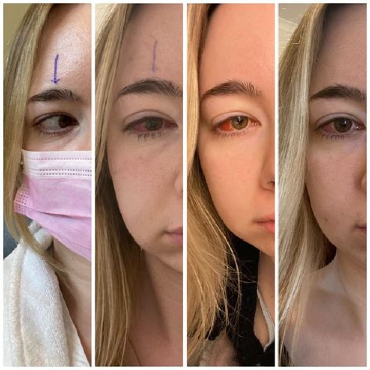 Will I need glasses after strabismus surgery?
